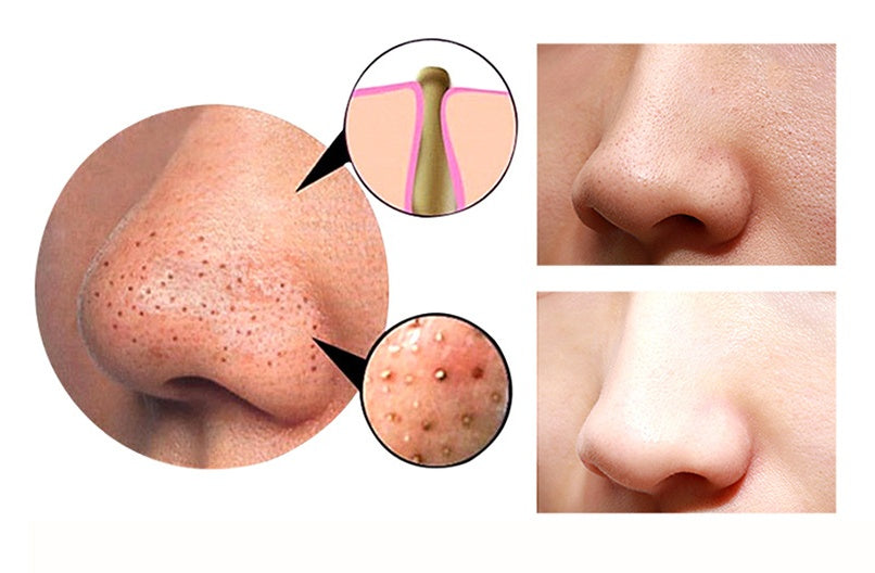 4-in-1 Body Gua Sha & Cupping Blackhead Remover – Facial Pore Deep Cleansing Skin Care Beauty Device