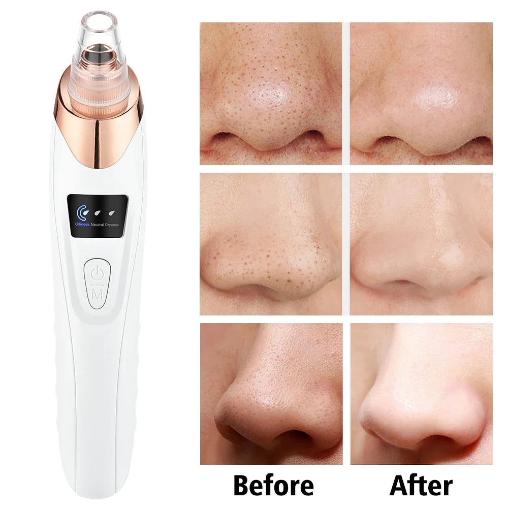 Professional Blackhead Remover Vacuum – Electric Pore Cleaner for Acne, Pimples & Deep Facial Cleansing