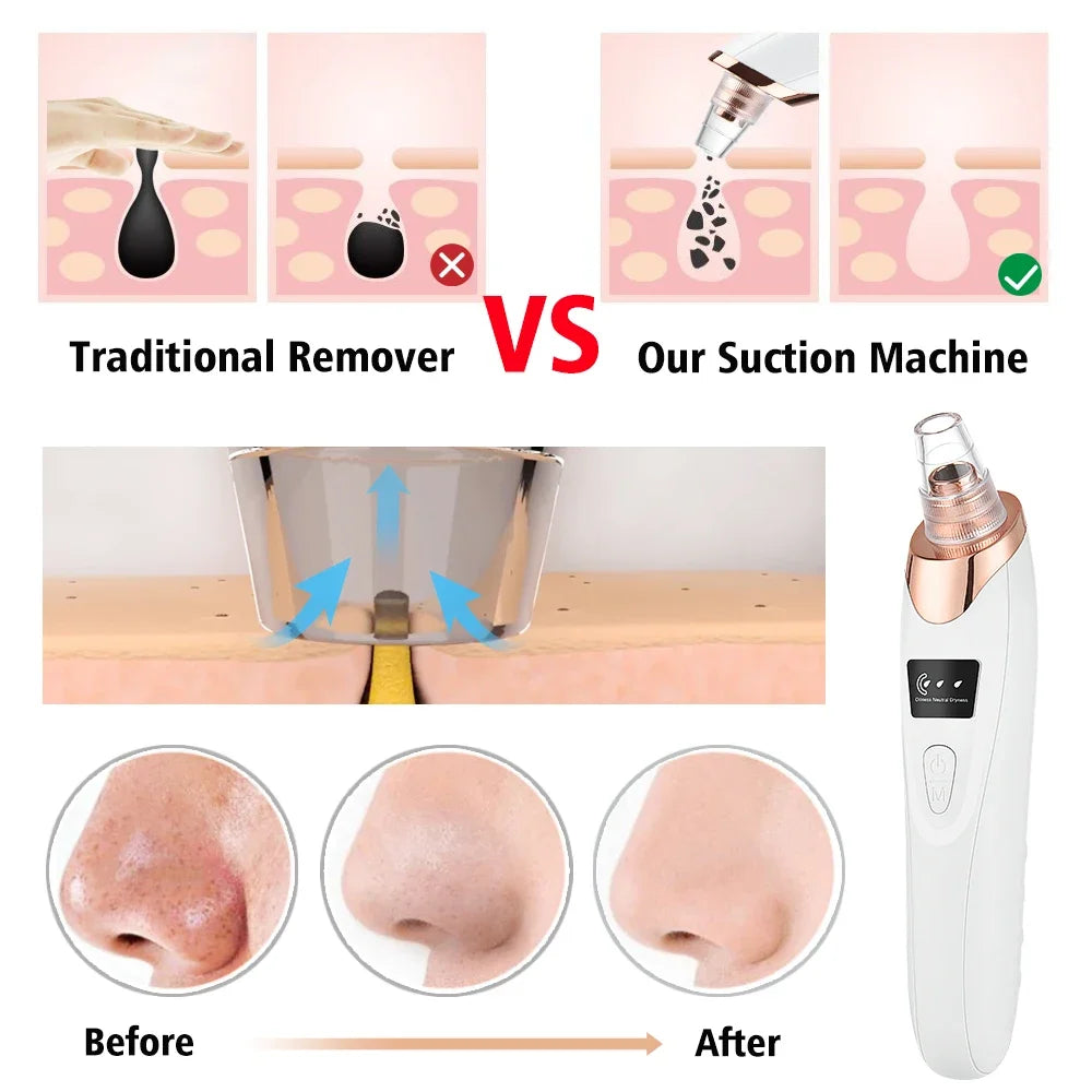 Professional Blackhead Remover Vacuum – Electric Pore Cleaner for Acne, Pimples & Deep Facial Cleansing